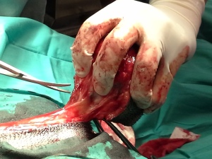 Extraction of tumour which was difficult as it was attached to nerve endings