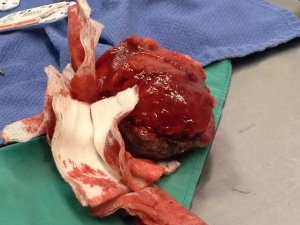 Tumour extracted and sent to lab-Results: Adenocarcinoma cancer that develops in the glandular tissues of the body