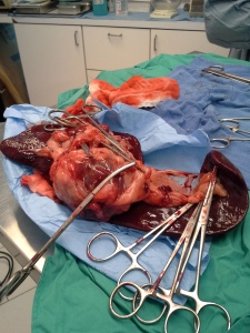 The Spleen with large tumour
